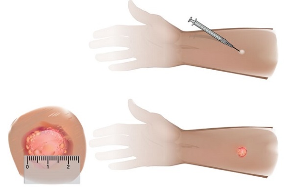 reakciya-mantu-norma-u-detej-2