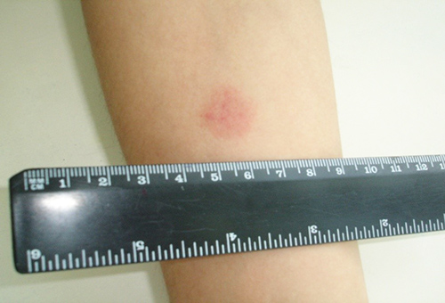 reakciya-mantu-norma-u-detej-4